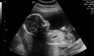 19 week ultrasound - Shannon Smith